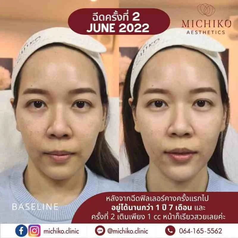 ฟิลเลอร์คาง