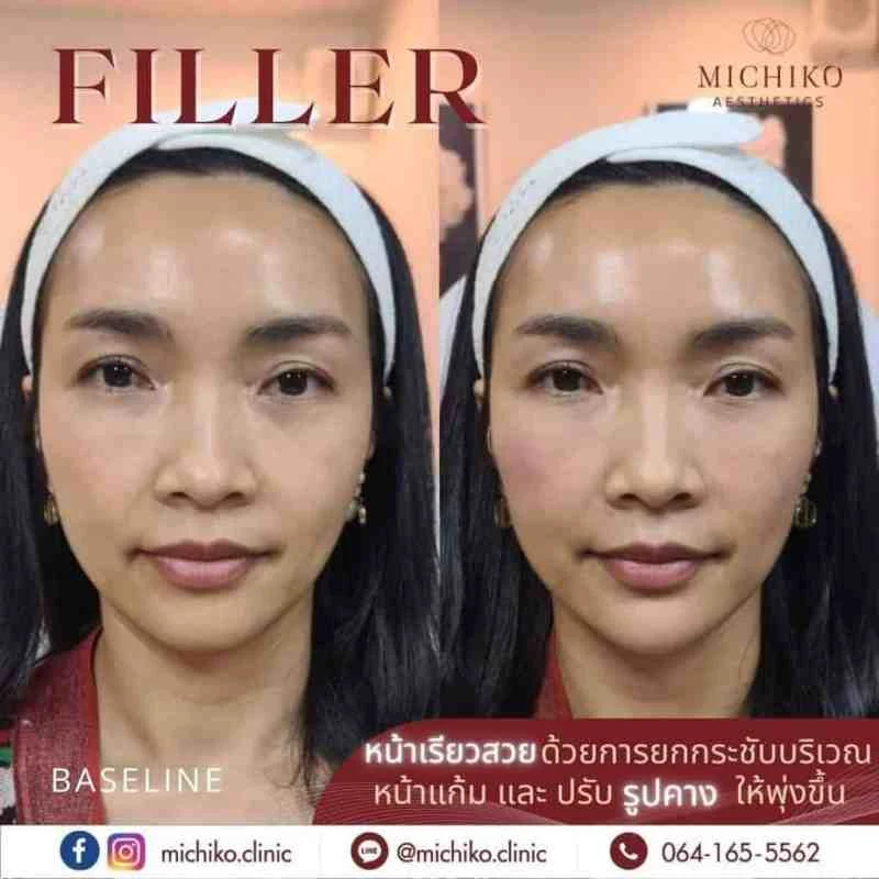 ฟิลเลอร์คาง