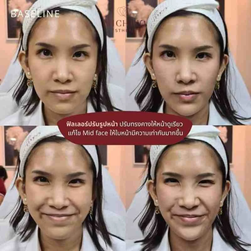 ฟิลเลอร์คาง
