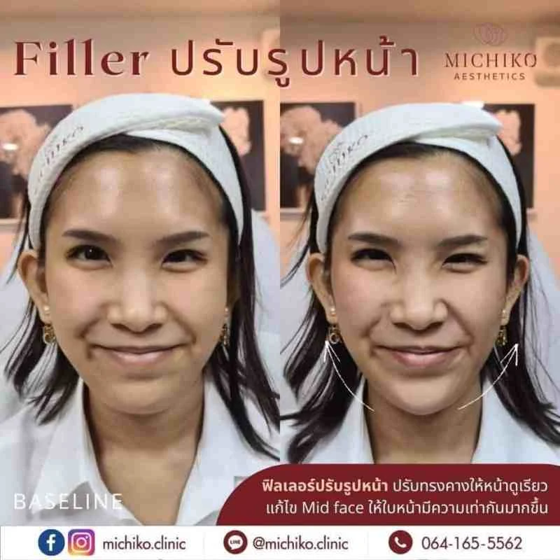 ฟิลเลอร์คาง