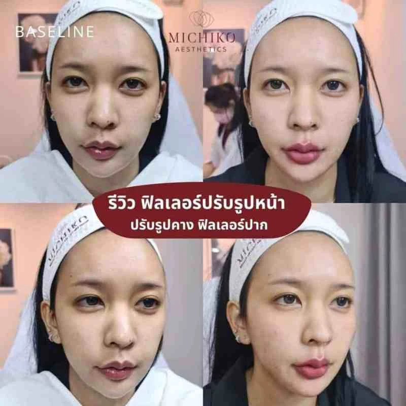 ฟิลเลอร์คาง