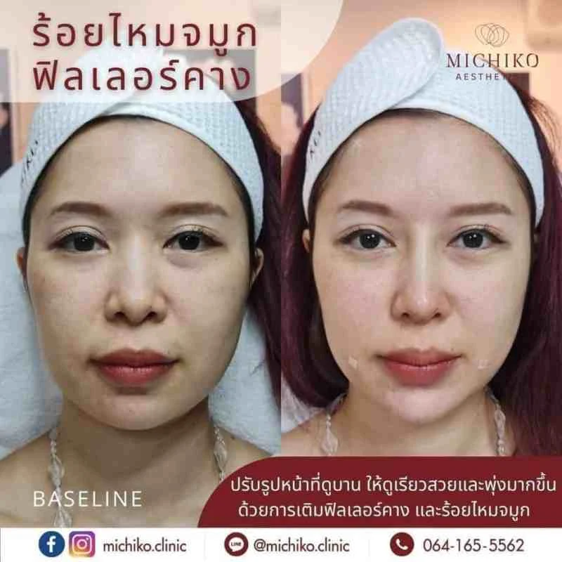 ฟิลเลอร์คาง