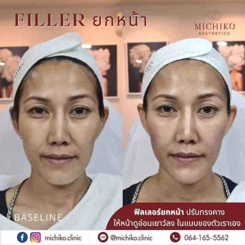 ฟิลเลอร์คาง