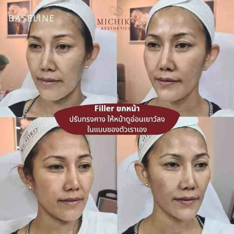 ฟิลเลอร์คาง