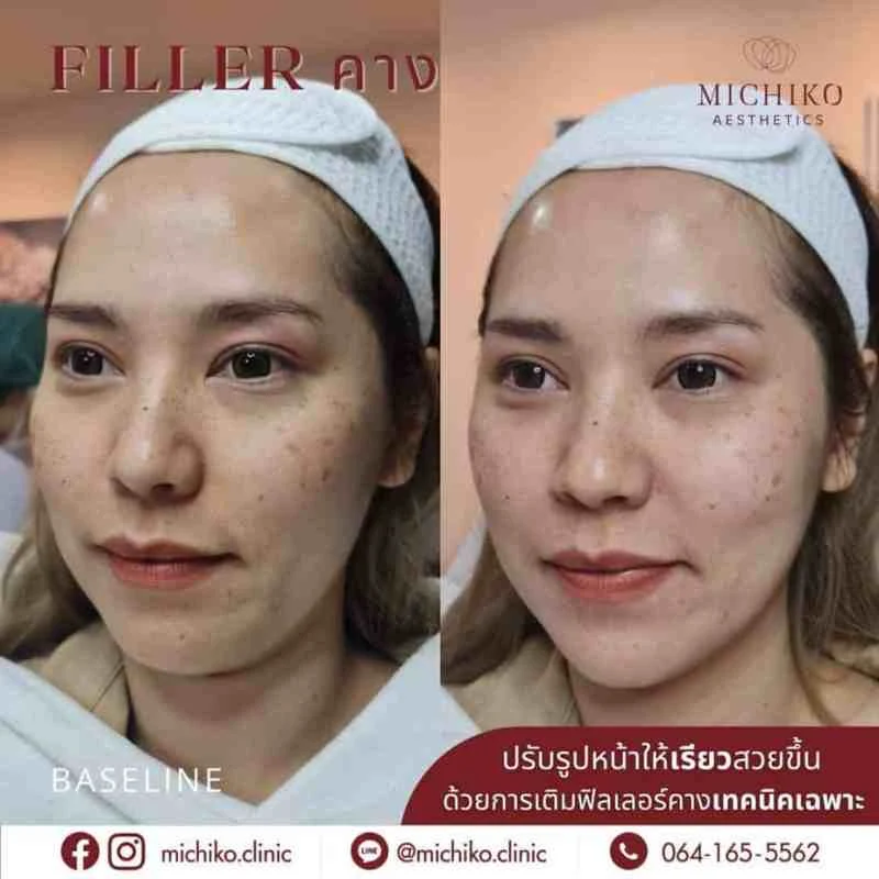 ฟิลเลอร์คาง