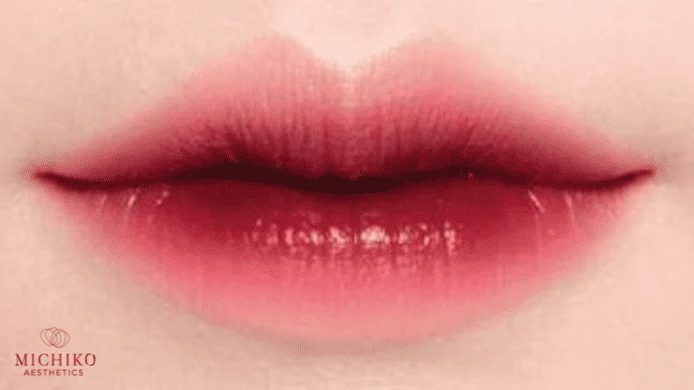 MICHIKO lips filler: cupids bow lip shape