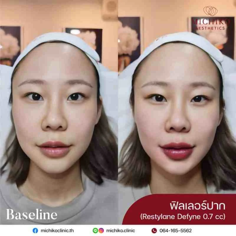 Lips Filler: an individual case