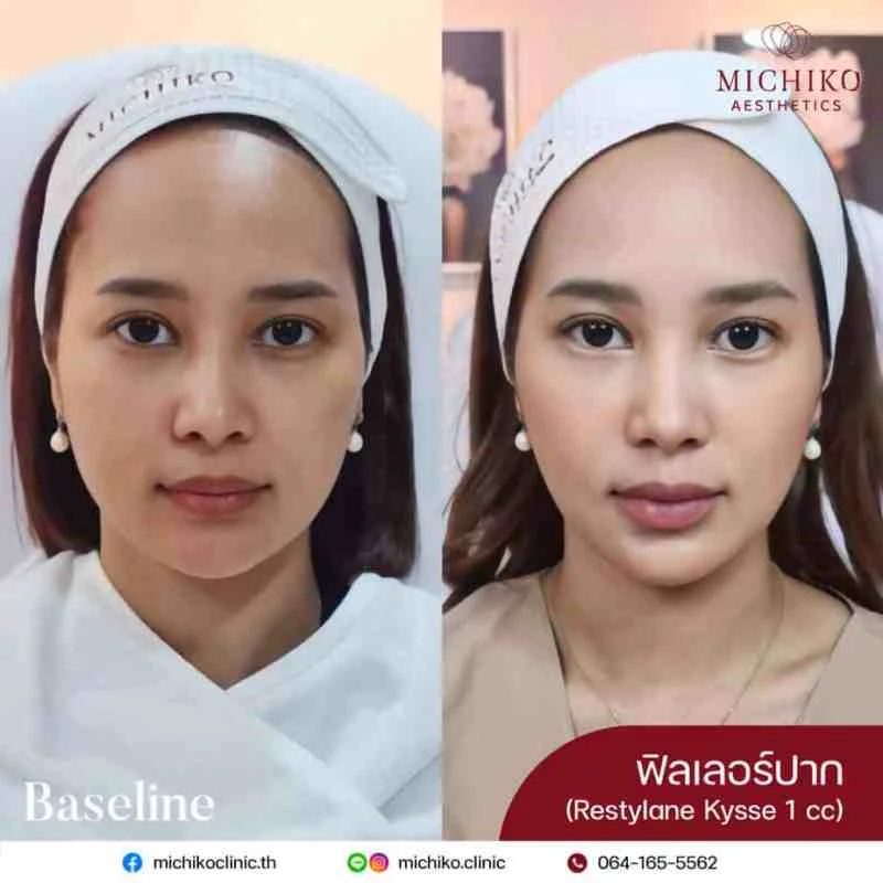 MICHIKO lips filler: treatment case 02