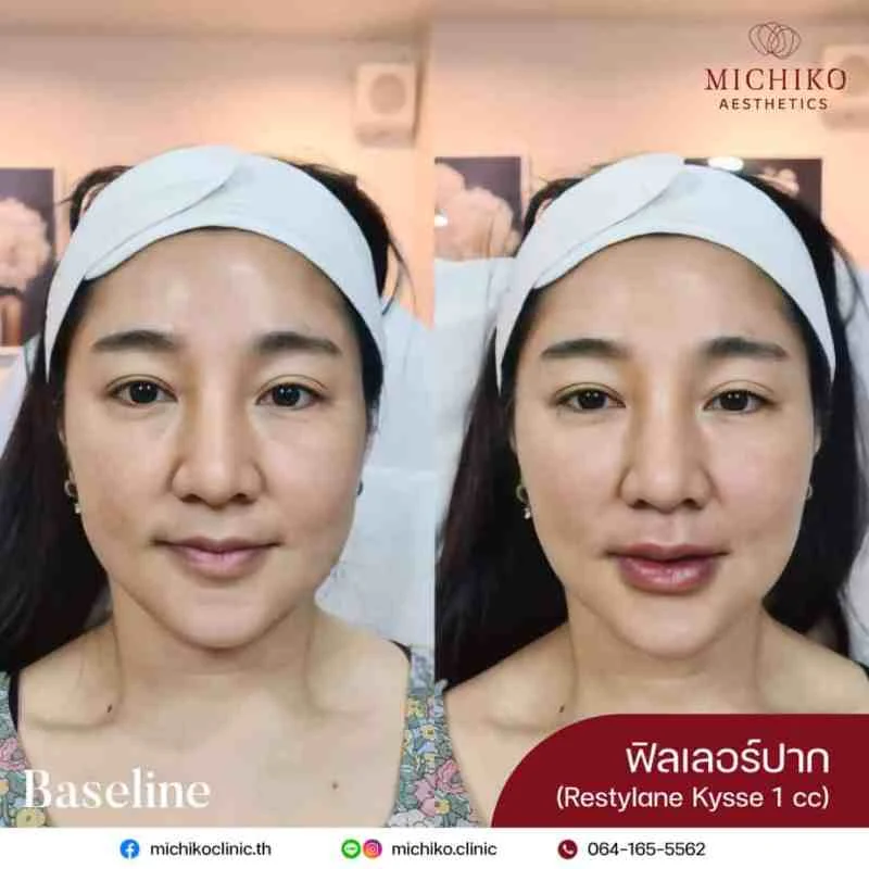 MICHIKO lips filler: treatment case 03
