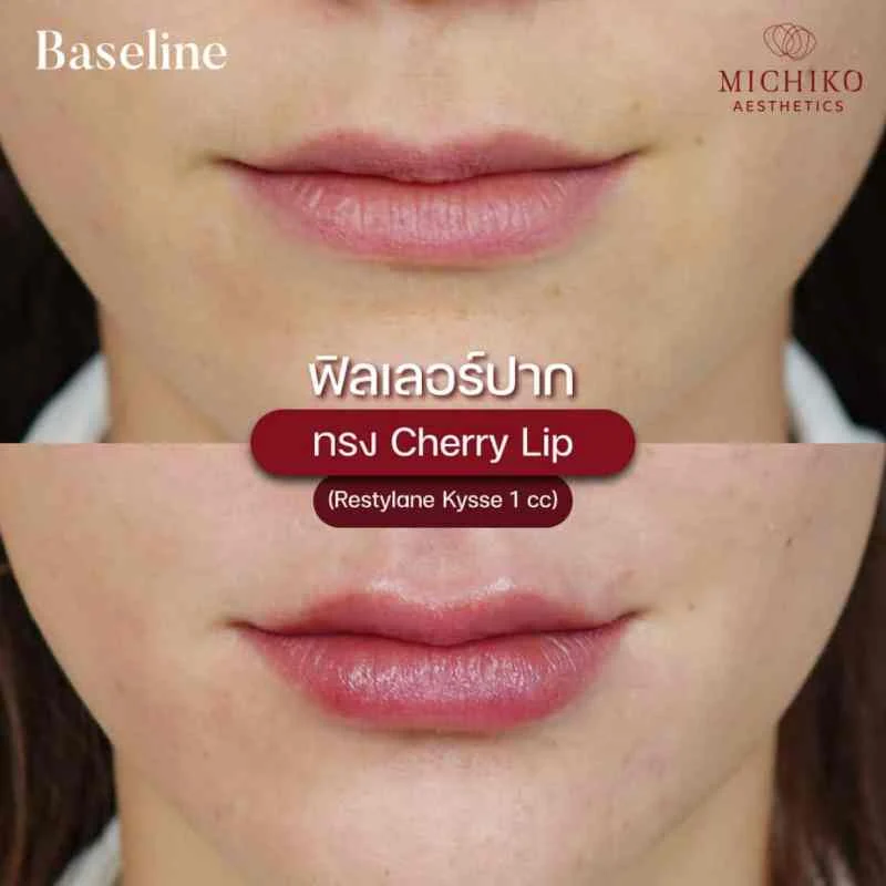 MICHIKO lips filler: treatment case 04