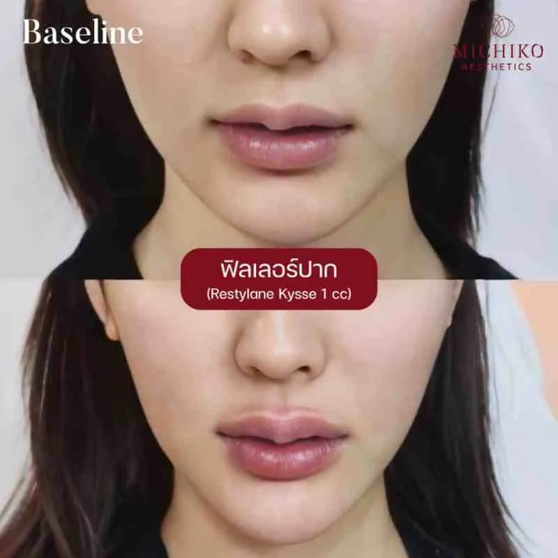 MICHIKO lips filler: treatment case 05