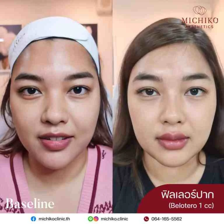MICHIKO lips filler: treatment case 06