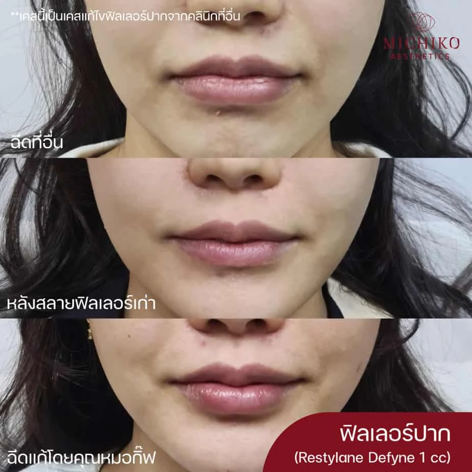 MICHIKO lips filler: treatment case 07