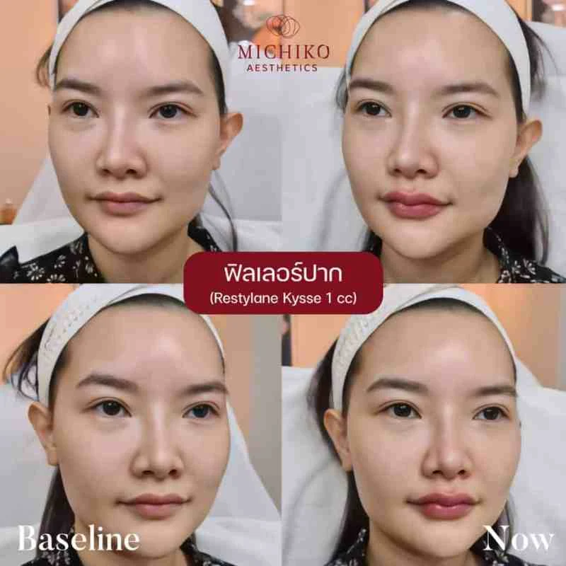 MICHIKO lips filler: treatment case 08
