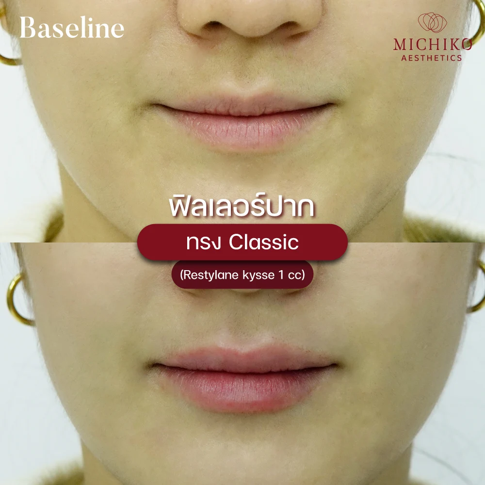 MICHIKO lips filler: treatment case 09