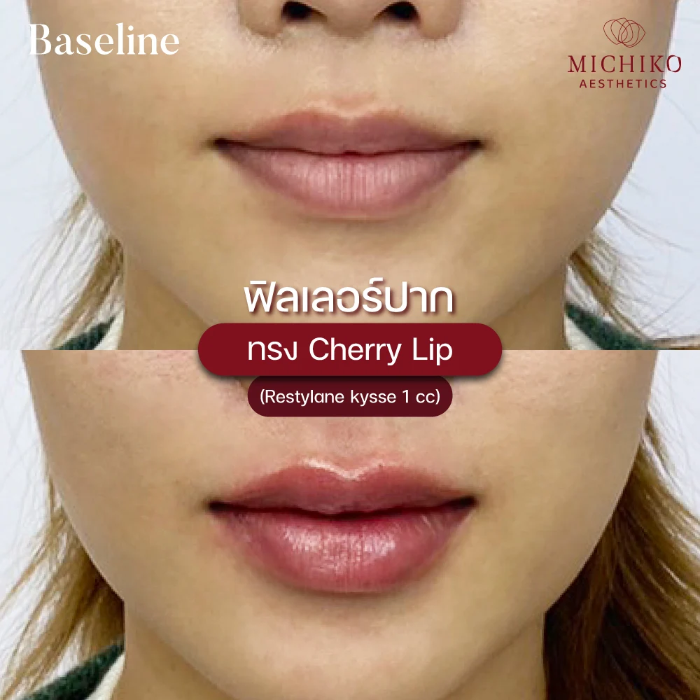 MICHIKO lips filler: treatment case 12