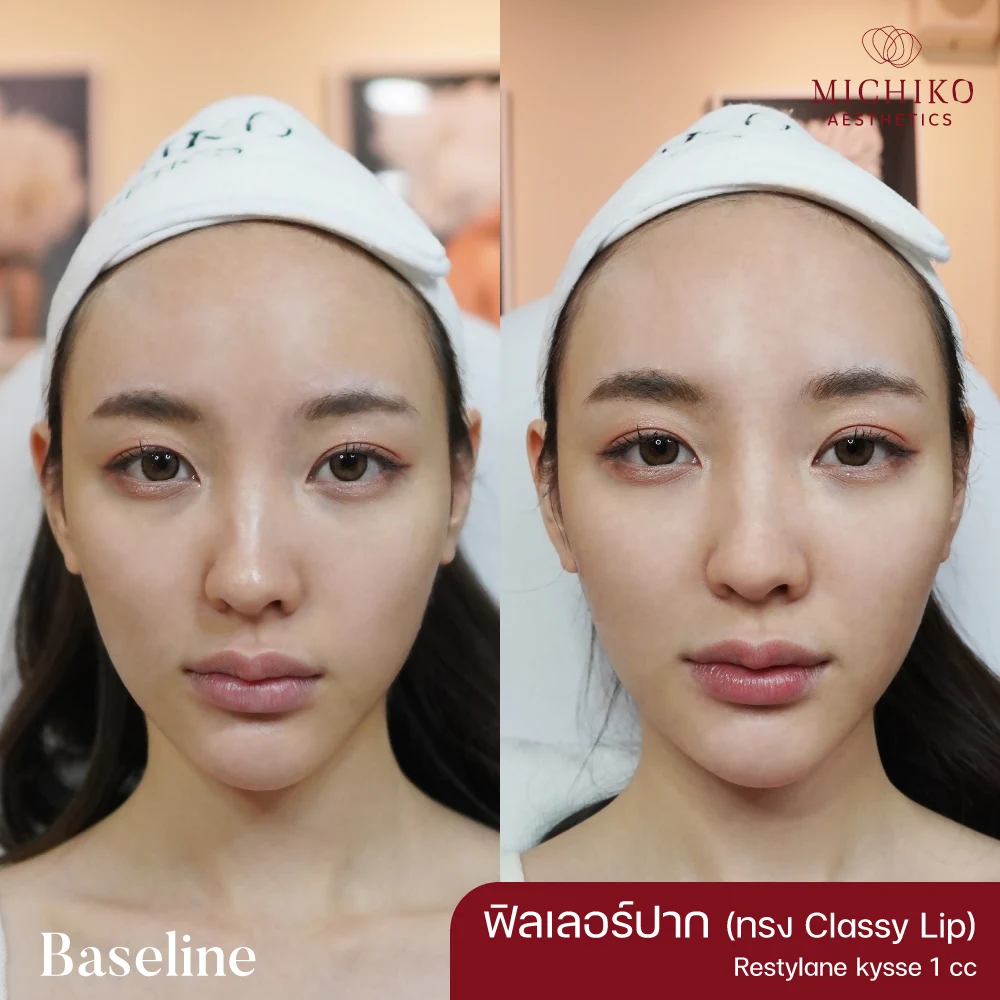 MICHIKO lips filler: treatment case 13