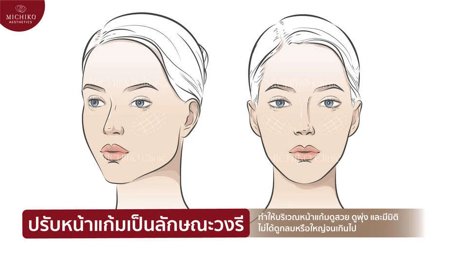 ฟิลเลอร์แก้ไข Mid-Face