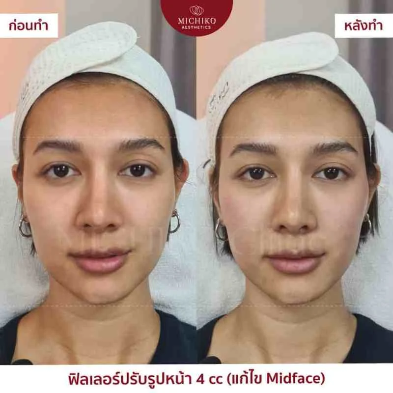 ฟิลเลอร์แก้ไข Mid-Face