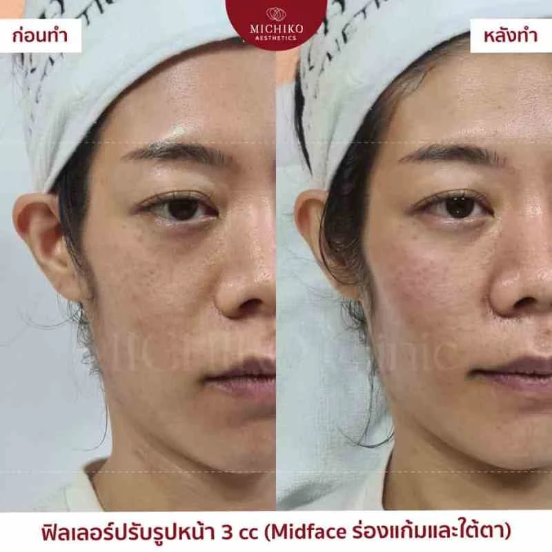 ฟิลเลอร์แก้ไข Mid-Face