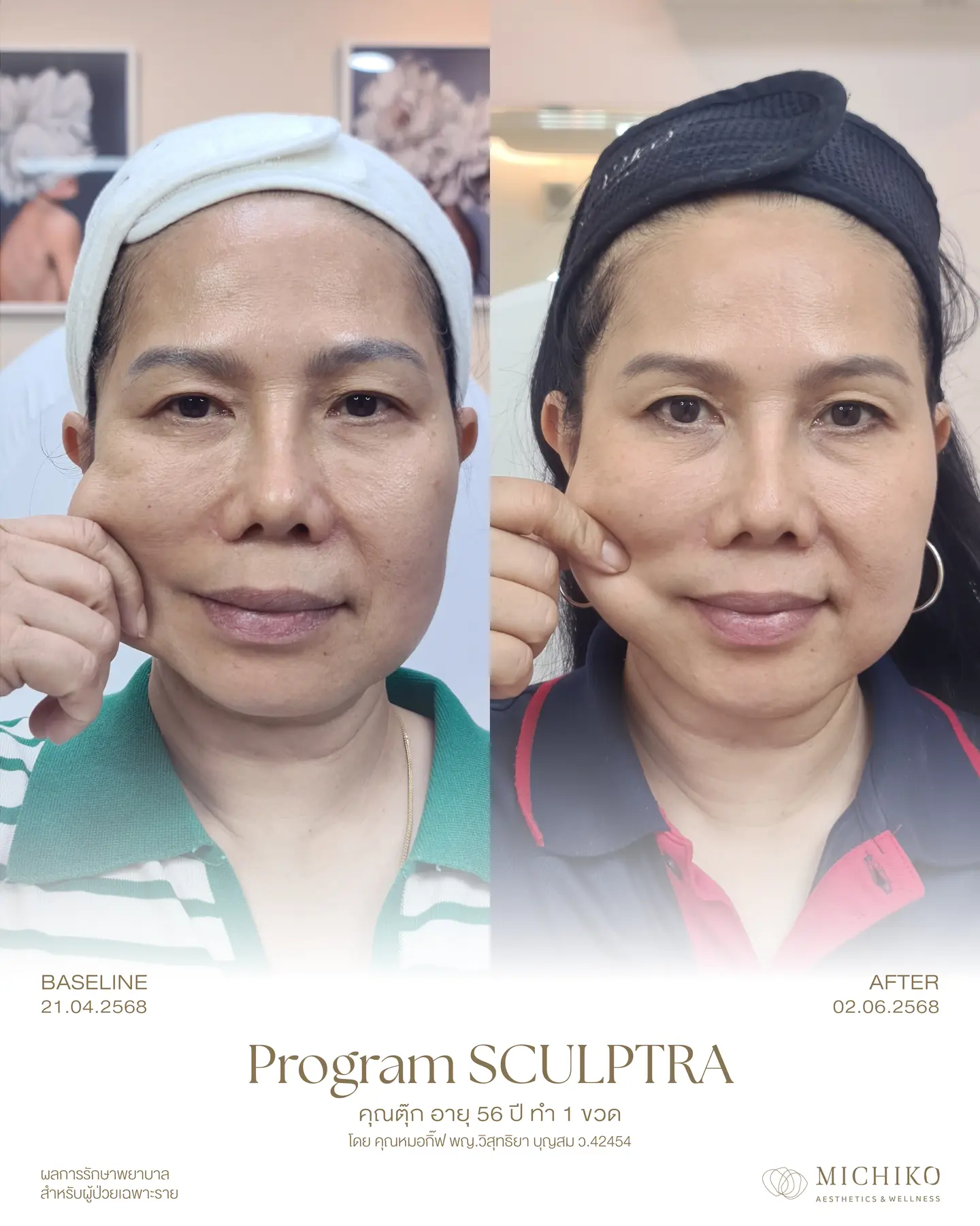 ภาพเคส Sculptra MICHIKO