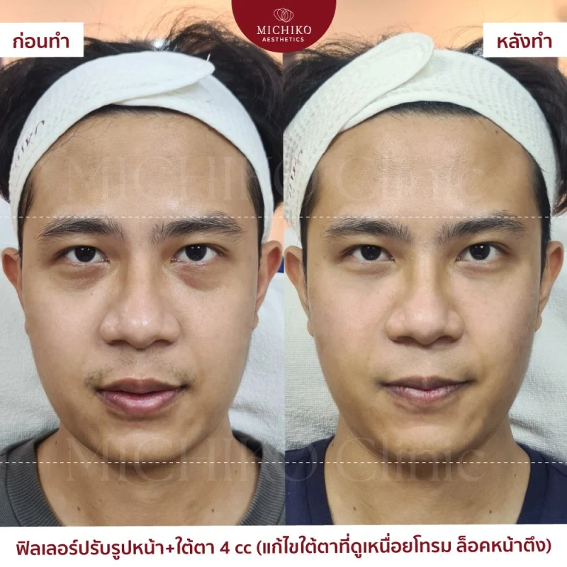 ใต้ตาดูสดใสขึ้น เมื่อดูแลร่วมกับโครงหน้า