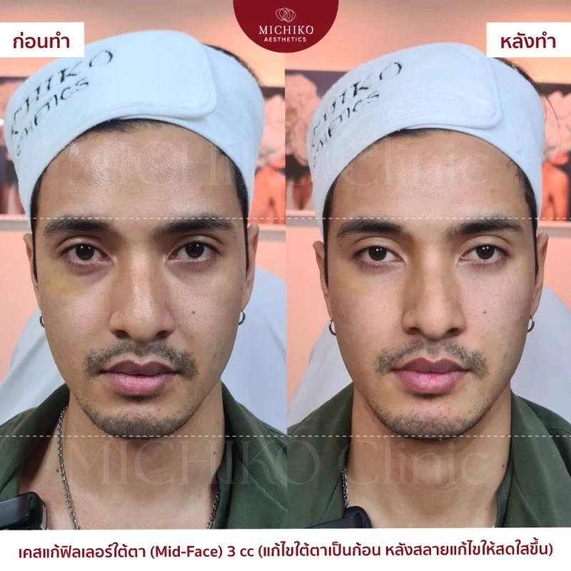 ฟิลเลอร์ใต้ตา รีวิว
