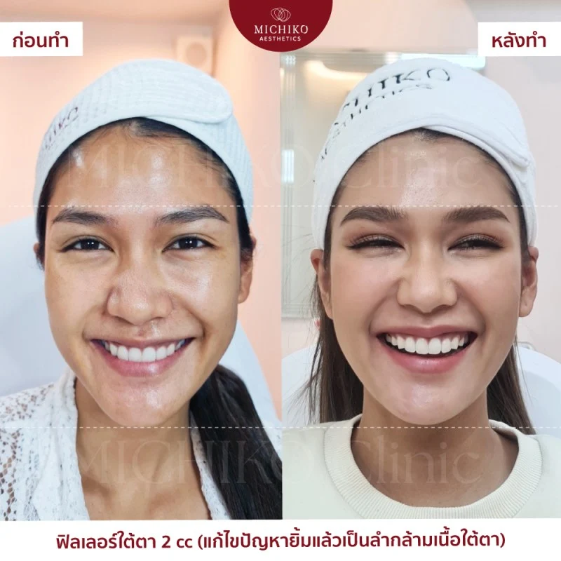 ฟิลเลอร์ใต้ตา รีวิว
