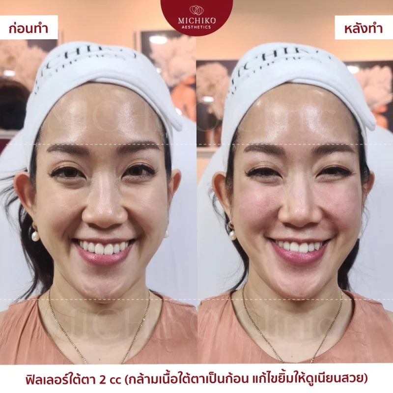 ฟิลเลอร์ใต้ตา รีวิว