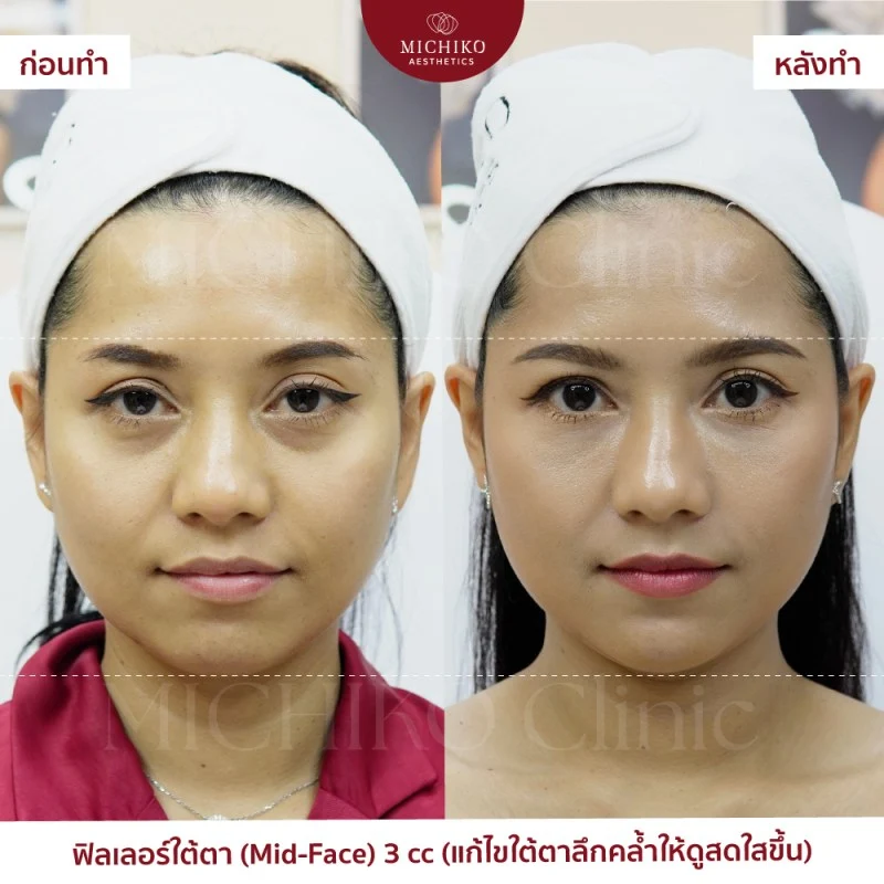 ฟิลเลอร์ใต้ตา รีวิว