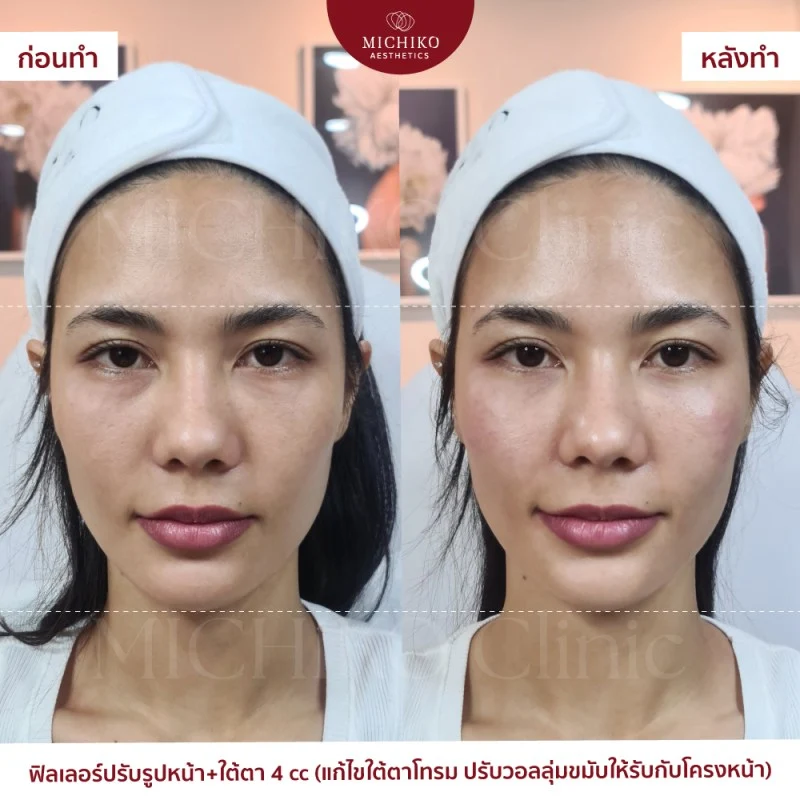 ฟิลเลอร์ใต้ตา รีวิว