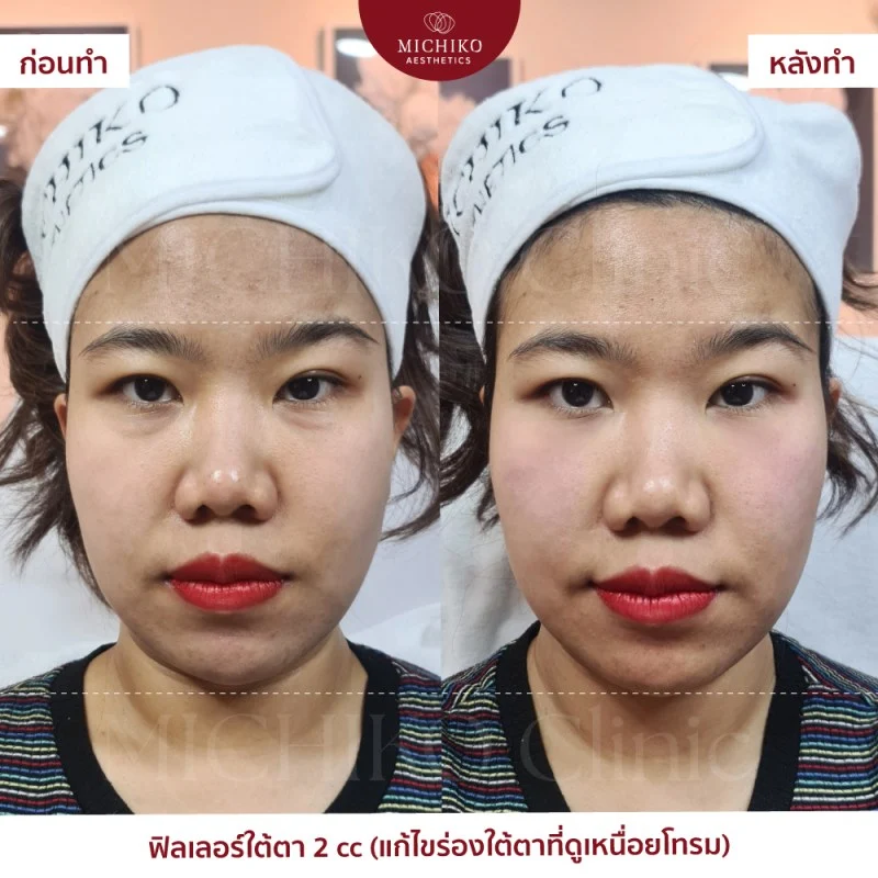 ฟิลเลอร์ใต้ตา รีวิว
