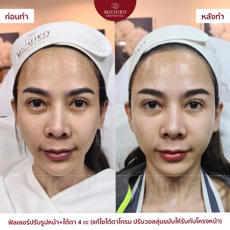 ฟิลเลอร์ใต้ตา รีวิว