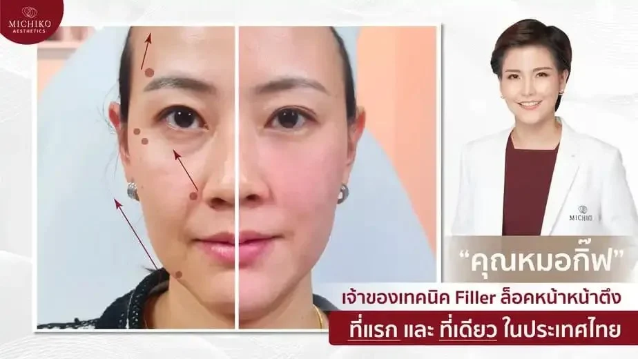 ภาพเคส Face-Lock Filler MICHIKO